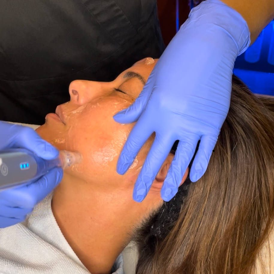 Microneedling